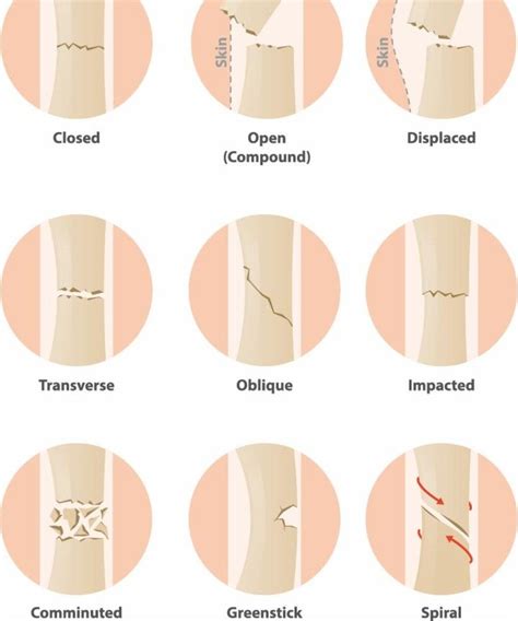 A Quick Summary Of The Different Types Of Fracture That Can Occur