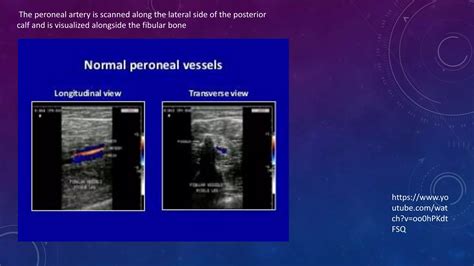 Lower Extremity Doppler Ultrasound Pptx