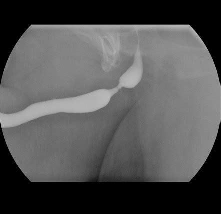 Urethral Stricture Radiology Reference Article Radiopaedia Org