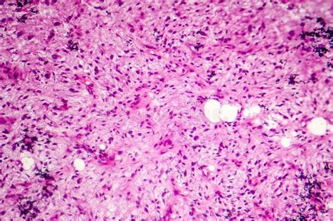 Liposarcoma; Symptoms, Diagnosis, and Treatment