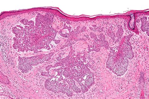 Skin Cancer Cells Vs Normal Cells