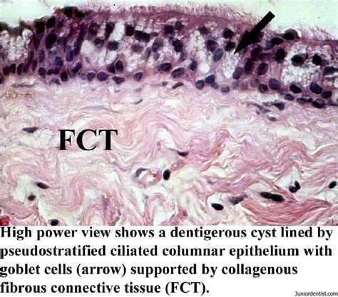 Dentigerous Cyst Definition, Clinical Features, Types, Radiographic ...