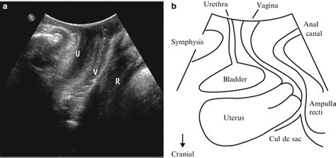 Pelvic Floor Ultrasound | Radiology Key