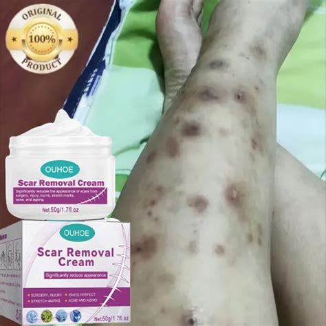 Original Peklat Remover Cream For Old Peklat Remove Scars Scar Remover