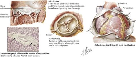 Acute Rheumatic Fever And Rheumatic Heart Disease Clinical Gate