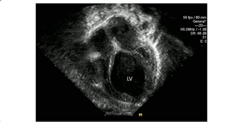 Echocardiography At 5 Weeks Of Life Showing Severely Dilated Left