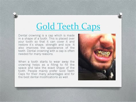 Gold teeth caps by Gold Teeth Caps - Issuu