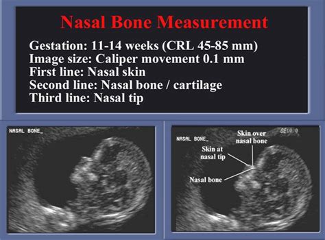 Hypoplastic Nose Ultrasounds