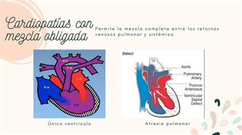 Cardiopatías Conmezcla Obligada Valentina Otálora Udocz