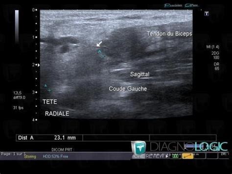 Radiology case : Biceps brachii tendon rupture (US) - Diagnologic