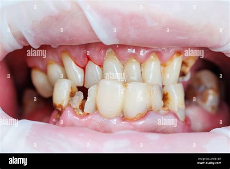 Spoiled Teeth Poor Dental Hygiene Caries Mouth Disease Shattered