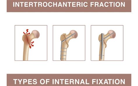 Hip Fracture Intertrochanteric: Causes, Diagnosis, and Treatment