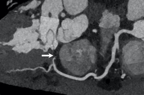 Role Of Coronary Ct Angiography In Spontaneous Coronary Artery