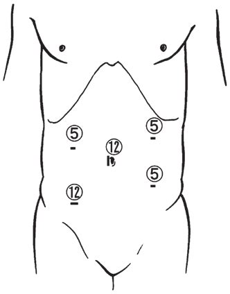 placement    laparoscopy ports  stapler insertion