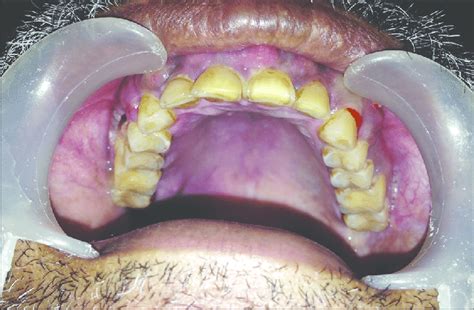 Multiple periodontal abscesses with bone exposure in the region of 14,... | Download Scientific ...