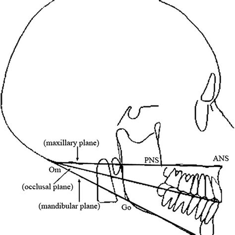 Histogram Showing The Divergence Of The Actual Occlusal Plane To The