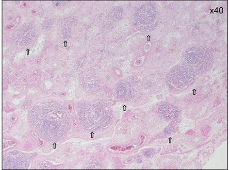 Full Text Multifocal Testicular Capillary Hemangioma International