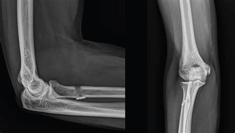 Lesiones Del Tend N Distal Del B Ceps Diagn Stico Y Tratamiento