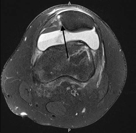 Vastus Medialis Oblique Mri