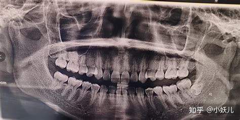 浙江省口腔医院 洗牙、拔智齿、补牙经历分享 知乎