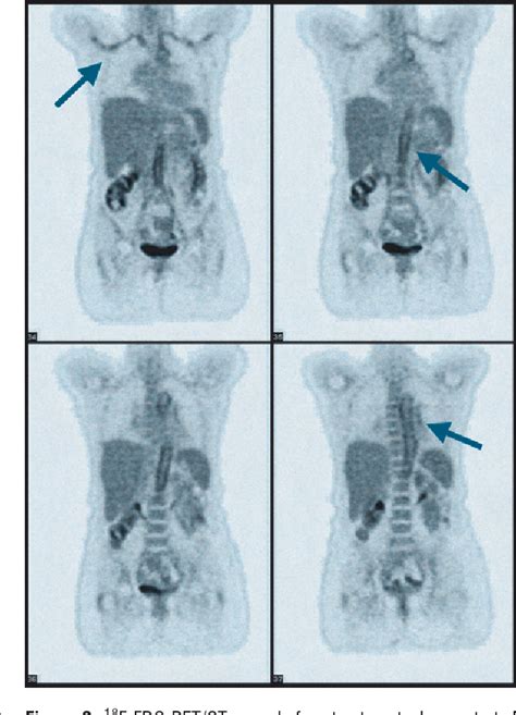 Figure 2 From A Case Of Fever Of Unknown Origin 18 F FDG PET CT