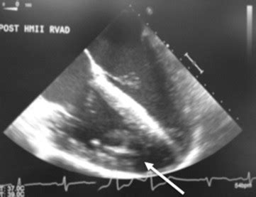 Ventricular Assist Device For Failing Systemic Ventricle In An Adult