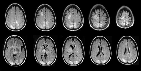 Hypertensive Encephalopathy