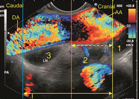 Techniques Of Linear Endobronchial Ultrasound Intechopen