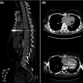 Postoperative Electrocardiogram Gated Computed Tomography Angiography