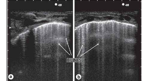 Figure 1 From Lung Ultrasound In Respiratory Distress Syndrome A Useful Tool For Early