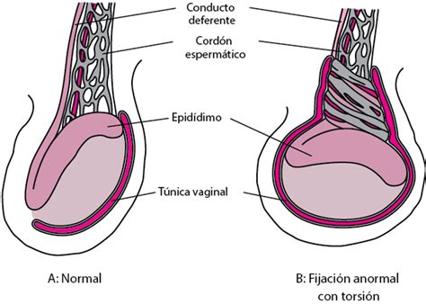 Como Acontece A Torção Testicular - Torsión testicular - Torsión testicular - Manual MSD versión para ...