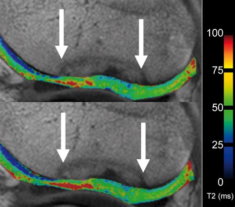 Quantitative T2 Mapping Of Knee Cartilage Differentiation Of Healthy