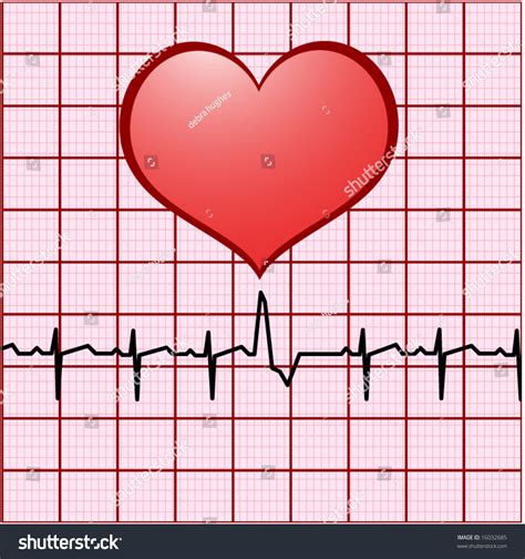 Przykładowe Ekg Z Opisem 3
