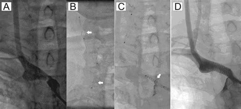 A Critical Innominate Artery Stenosis At Angiography B Two Spiderfx