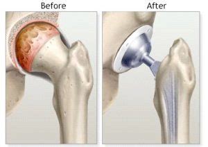 Total Hip Replacement What S Involved Central Health Physiotherapy