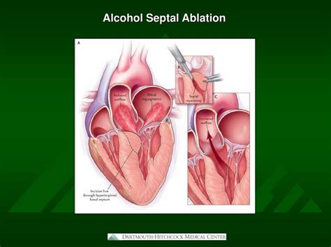 PPT Alcohol Septal Ablation In Hypertrophic Obstructive