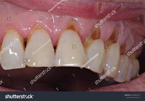 1,222 Abrasion teeth Stock Photos, Images & Photography | Shutterstock