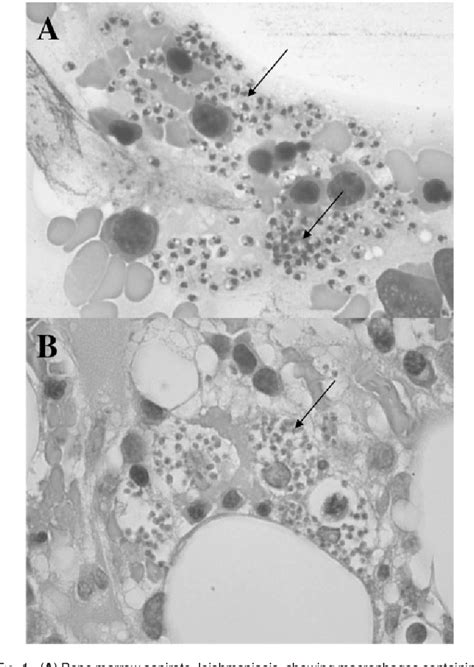 Figure 1 From Rituximab In Rheumatoid Arthritis Following Anti Tnf Associated Tuberculosis