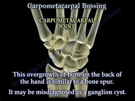 Icd 10 Code For Calcaneal Bursitis