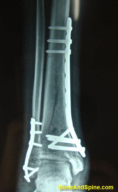 Radiographs Of Tibia Fibula Fracture Bone And Spine