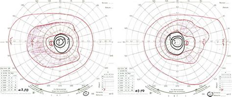 50 Rétinopathies Paranéoplasiques Syndromes Cancer Associated Retinopathy Car Et Melanoma