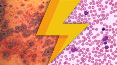 Lightning Learning Immune Thrombocytopenia Itp — Em3