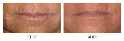 Before And After Cleopatra Laser Skin Clinic