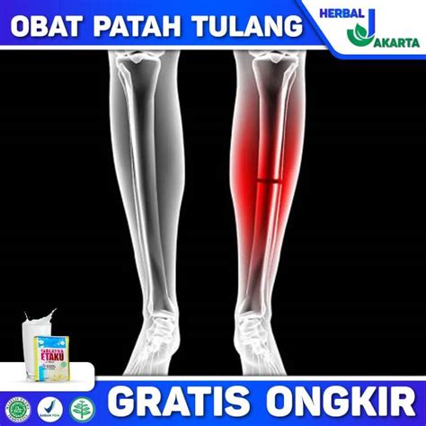 Obat Patah Tulang, Patah Tulang Belakang, Patah Tulang Ekor, Patah ...