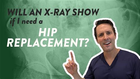 Will An X Ray Show If I Need A Hip Replacement Dr Geier