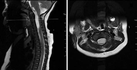 Preoperative Sagittal Left And Axial Right T2 Weighted Mri Showed A