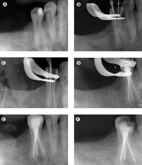 Panel Of Periapical Radiographs Documenting Teh Case A Preoperative