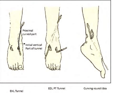 Tendon Transfer Surgery