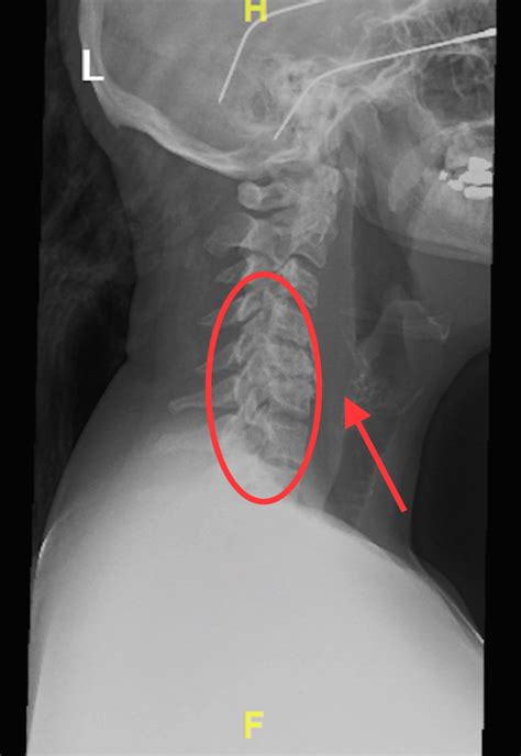 Soft tissue neck X-ray showing degenerative changes (within the oval ...