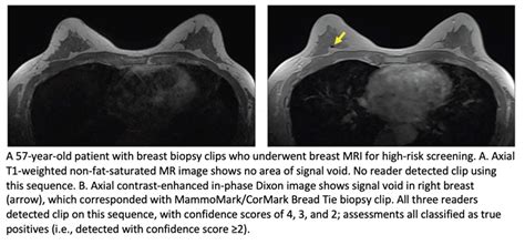 Contrast Enhanced In Phase Dixon Sequence For Detecting Breast Biopsy